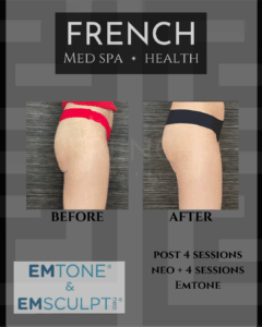 A before-and-after photo of a patient after 4 sessions of Emtone for cellulite reduction in St. Charles. The patient's legs are visibly smoother with less cellulite. 