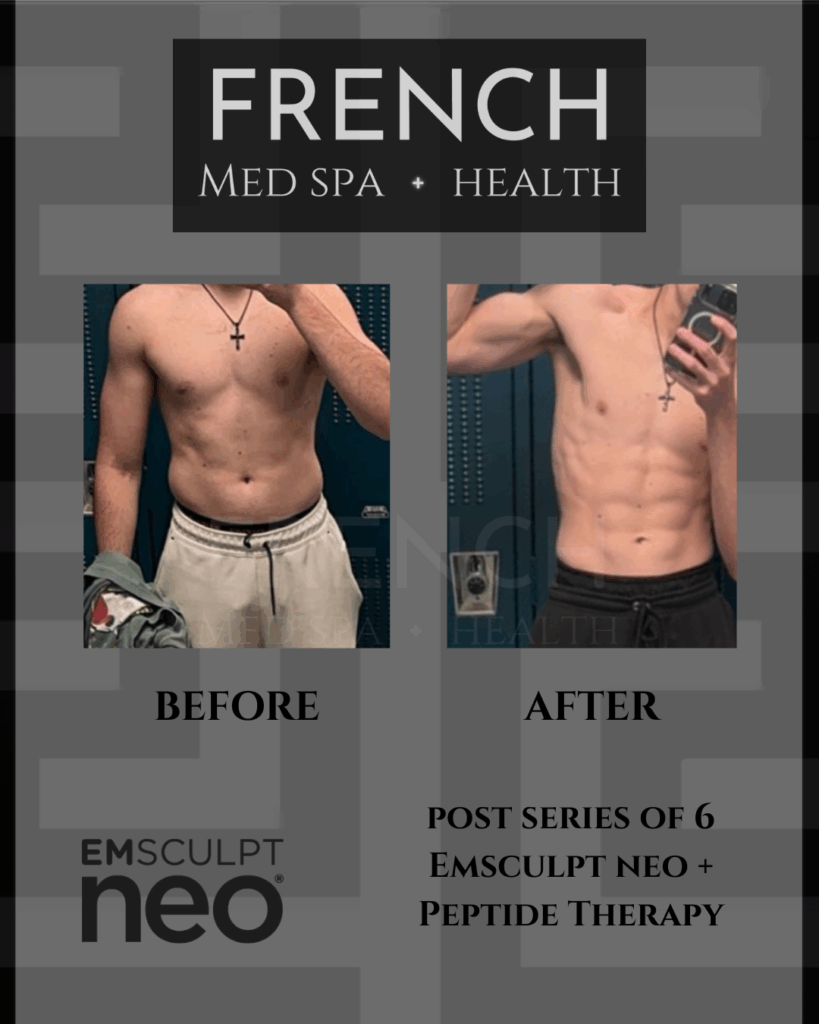 A patient's before-and-after photos reveal a chiseled core after consistent ab sculpting in St. Charles.